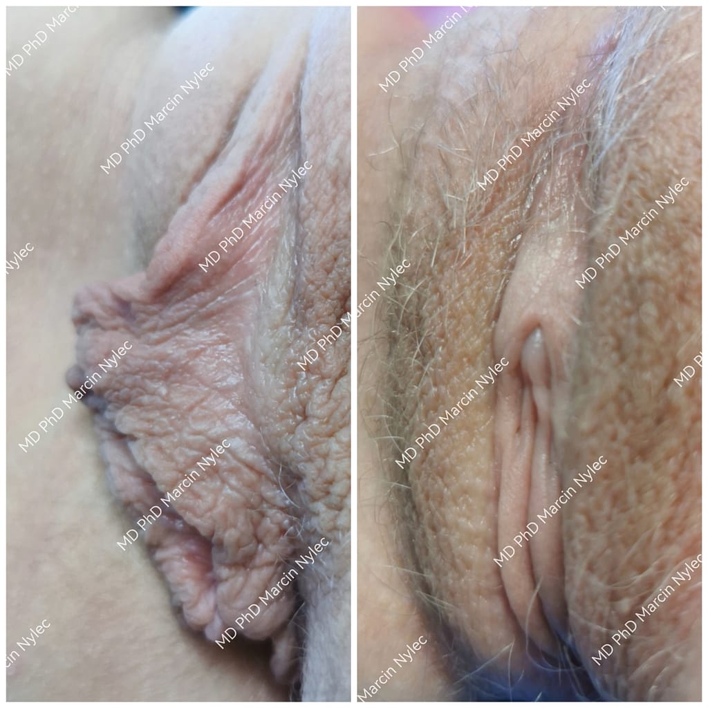 efekty labioplastyki w krakowie wykonanej przez dr Nylca zdjęcie nr 13