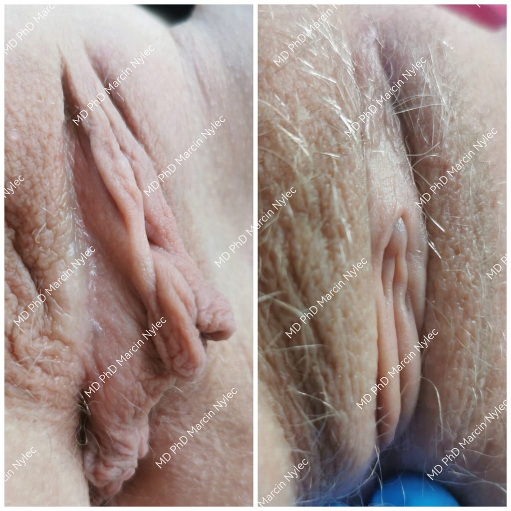 przed i po labioplastyce kraków pacjentka 17