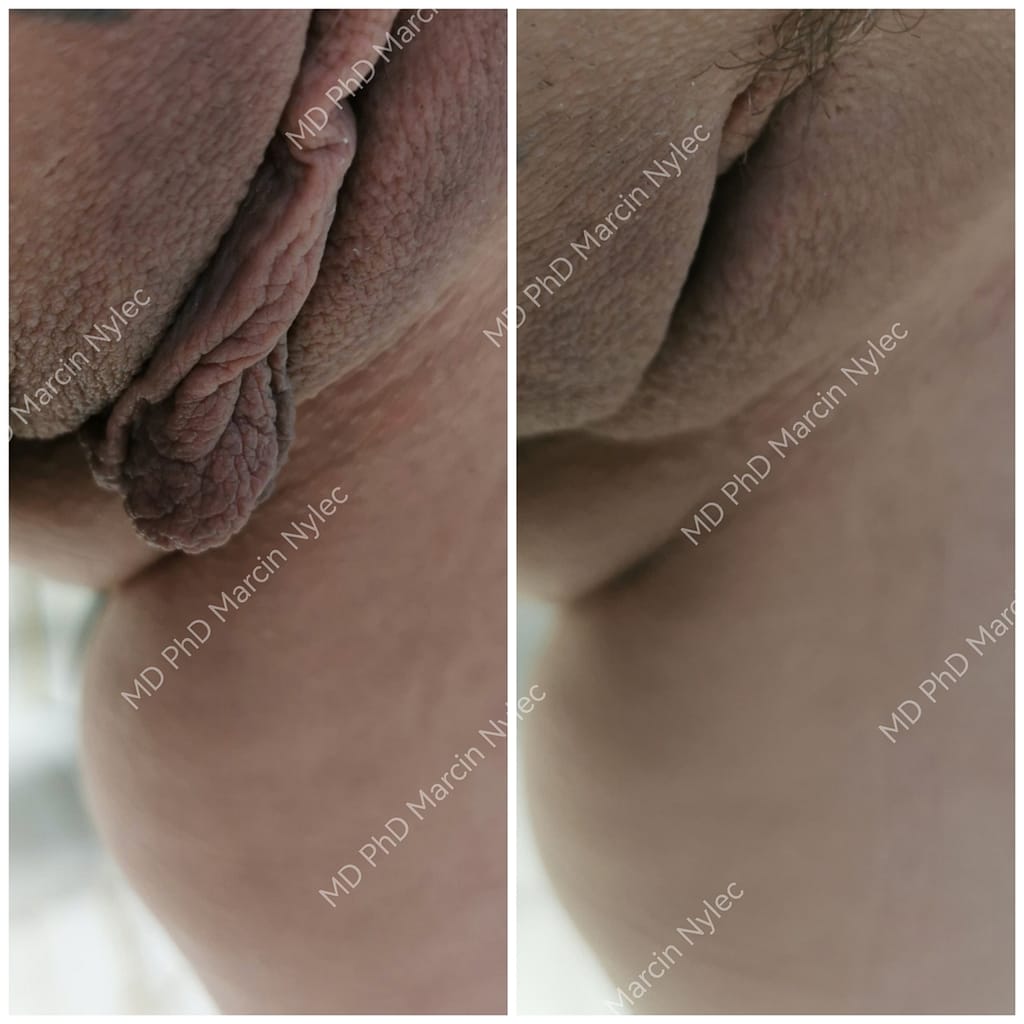 efekty labioplastyki w krakowie