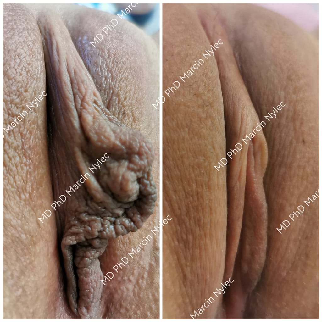 efekty labioplastyki w krakowie