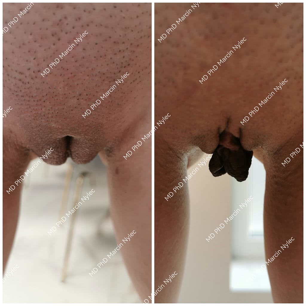 labioplastyka kraków przed i po zdjecie 39