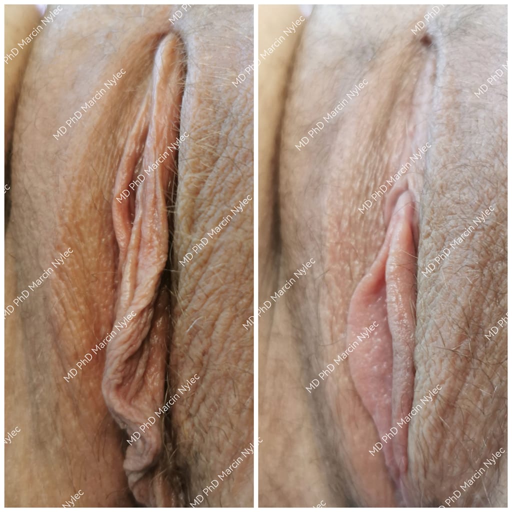 Labioplastyka przed i po u pacjentki 22 lata z Wrocławia, dwa zdjęcia w tej samej pozycji pokazujące naturalny efekt po zabiegu.