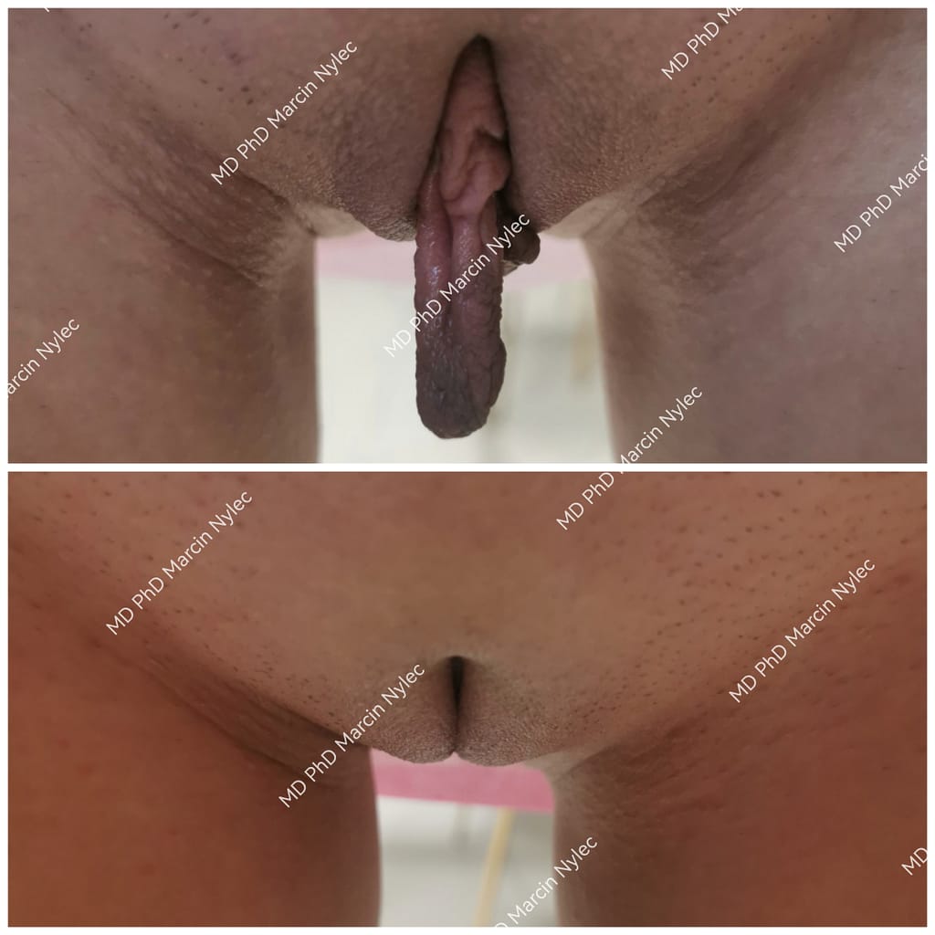Labioplastyka - pacjentka 520 - widok z przodu przed i po zabiegu