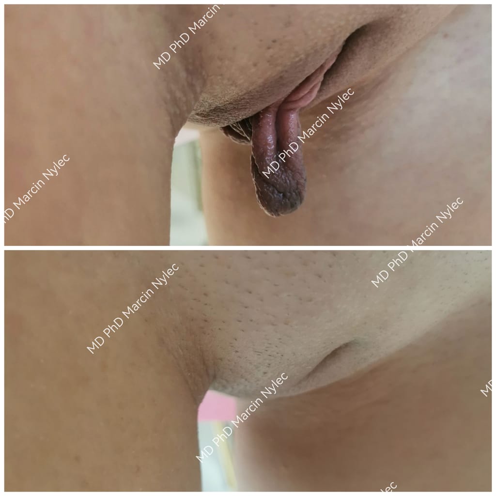 Labioplastyka - pacjentka 520 - widok z przodu przed i po zabiegu