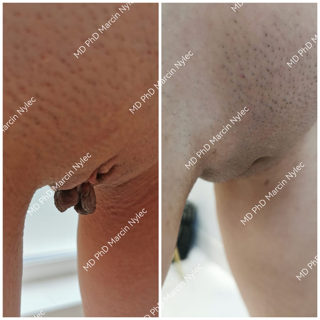 Efekty labioplastyki warg sromowych mniejszych przed i po - pacjentka 39 lat, poprawa kształtu i symetrii.