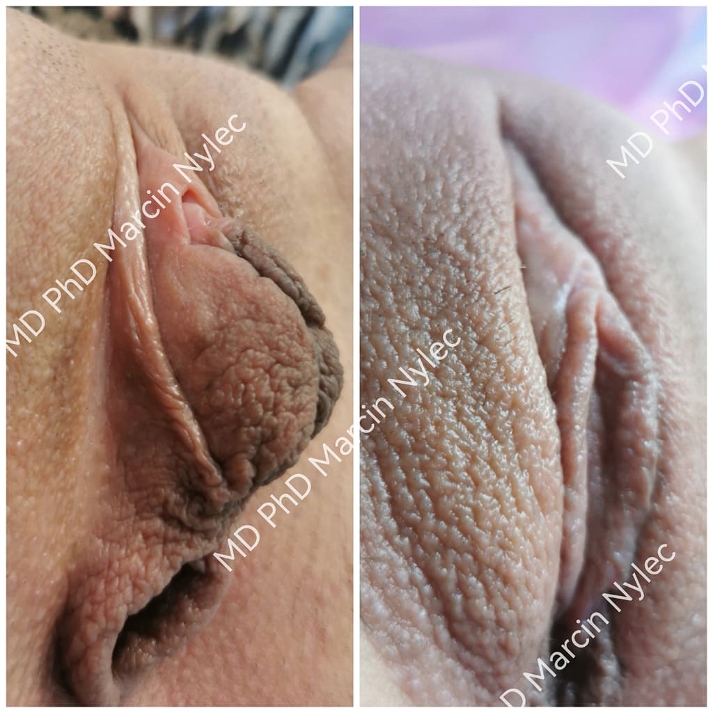 Efekty przed i po labioplastyce