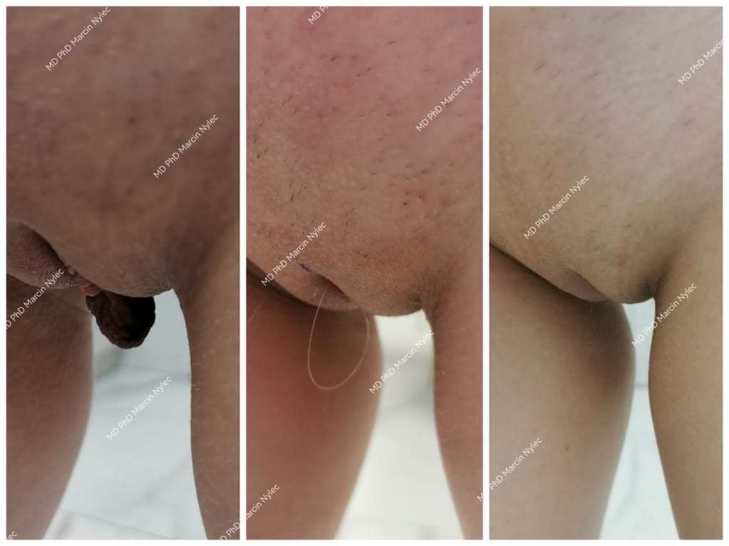 Labioplastyka Przed & Po Pacjent #642 zdjęcie #111