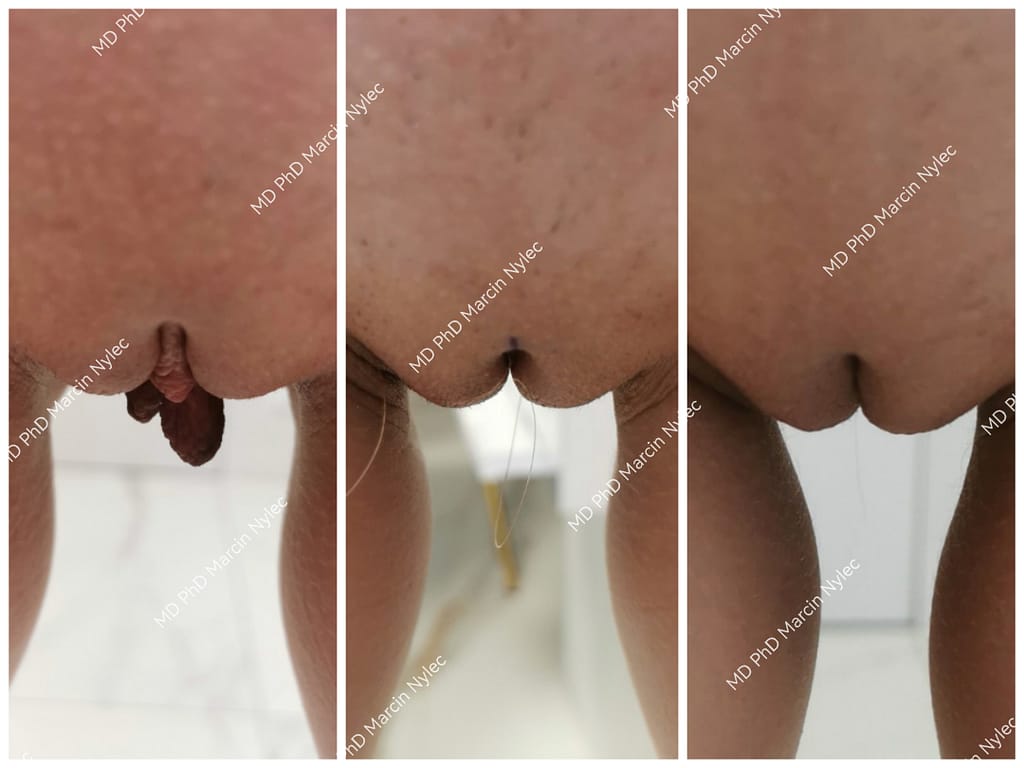 Labioplastyka Przed & Po Pacjent #642 zdjęcie #123