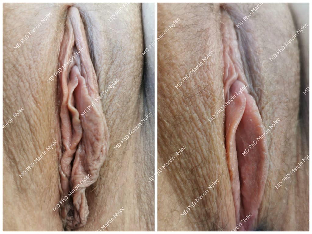 Kolaż zdjęć przed i po labioplastyce u 22-letniej pacjentki z Wrocławia, po lewej przed zabiegiem, po prawej efekt po zabiegu.