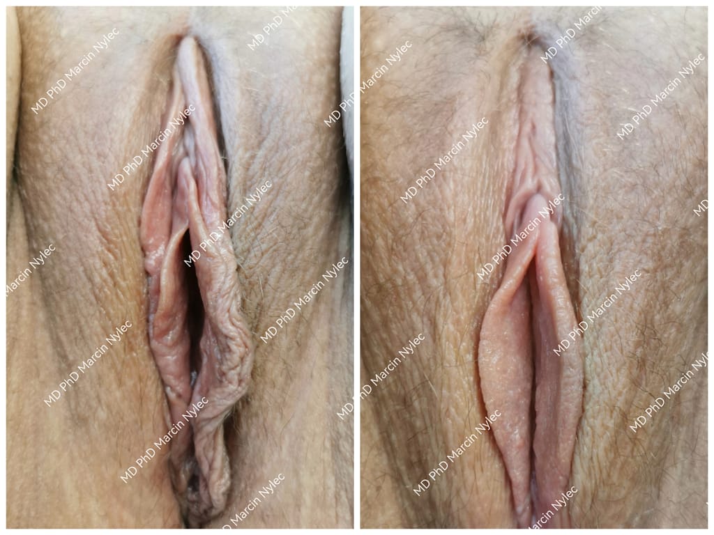 Porównanie przed i po labioplastyce warg sromowych mniejszych u pacjentki 22 lata z Wrocławia, widoczna poprawa kształtu i długości warg.