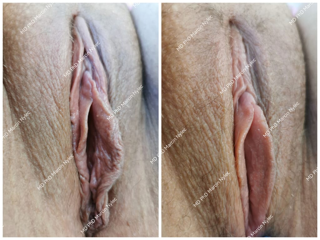 Kolaż przed i po plastyce warg sromowych mniejszych oraz napletka łechtaczki u 22-letniej pacjentki z Wrocławia, redukcja przerośniętych tkanek.