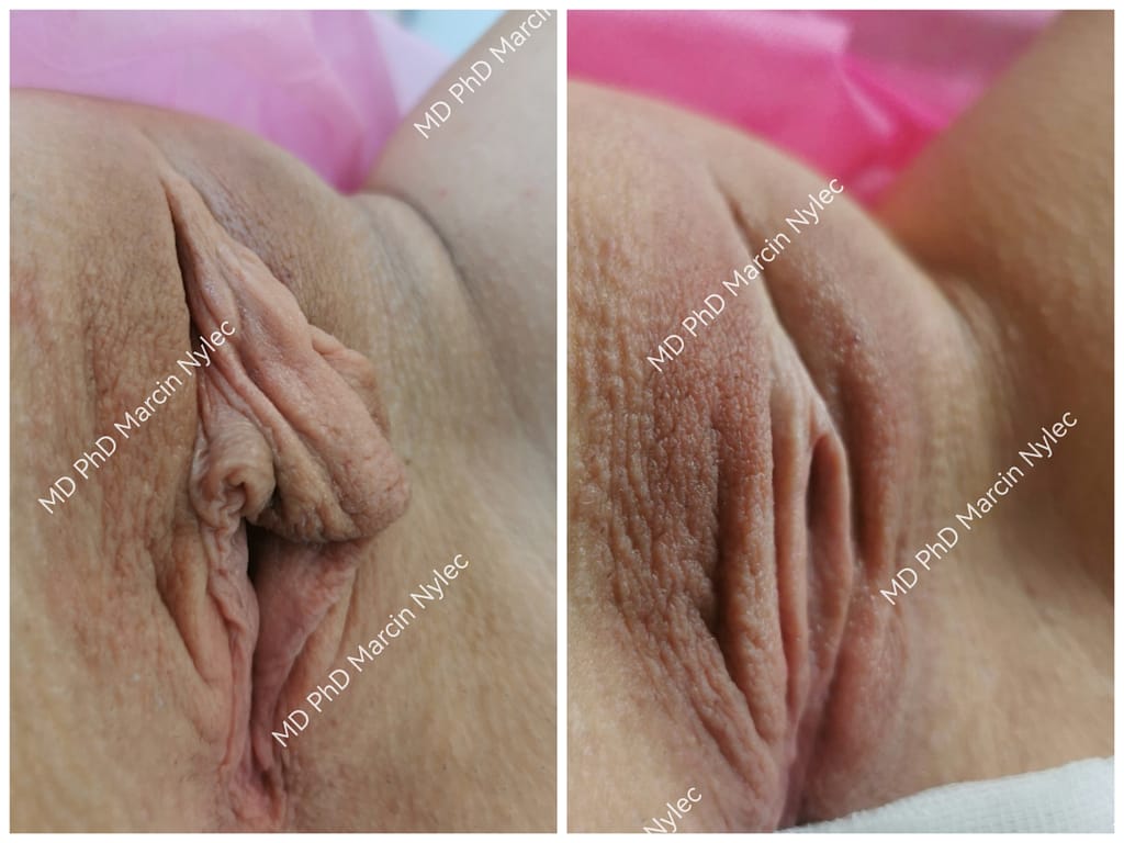 Labioplastyka - pacjentka 525 - pozycja leżąca na fotelu ginekologicznym, widok z przodu, kolaż zdjęć przed i po ukazujący efekt zabiegu