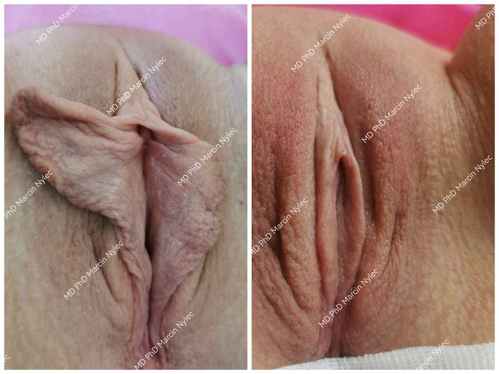 Labioplastyka - pacjentka 525 - pozycja leżąca, widok z przodu, kolaż dwóch zdjęć - przed oraz po zabiegu - ukazujący efekt labioplastyki