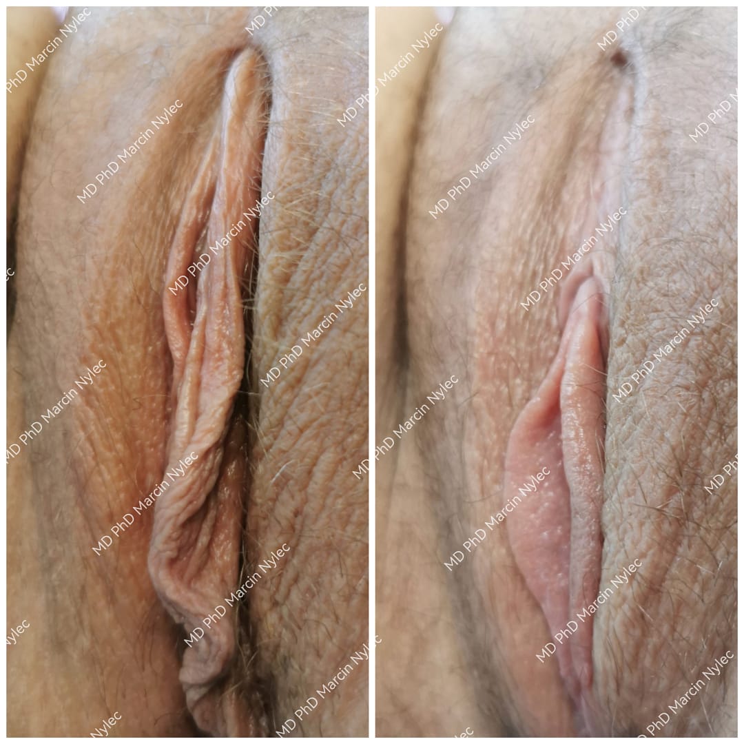 Pacjentka #620. Labioplastyka u 22-letniej pacjentki z Wrocławia