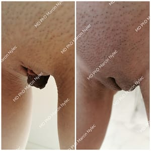 Zdjęcie porównawcze przed i po labioplastyce - pacjentka 39 lat, redukcja przerostu warg sromowych mniejszych.