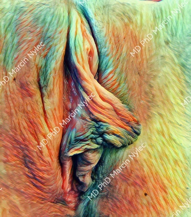 Zdjęcie przedstawiające przerost warg sromowych oraz napletka łechtaczki z prawej strony przed operacją