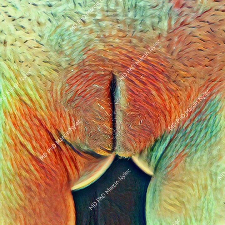 Pacjentka po labioplastyce, widok warg sromowych od przodu w pozycji stojącej