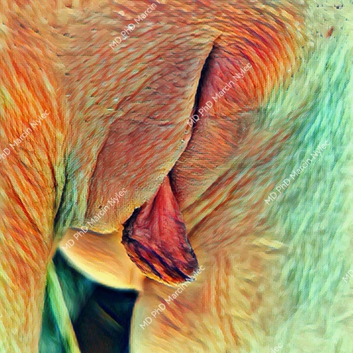 Widoczny przerost warg sromowych mniejszych z lewej strony przed zabiegiem