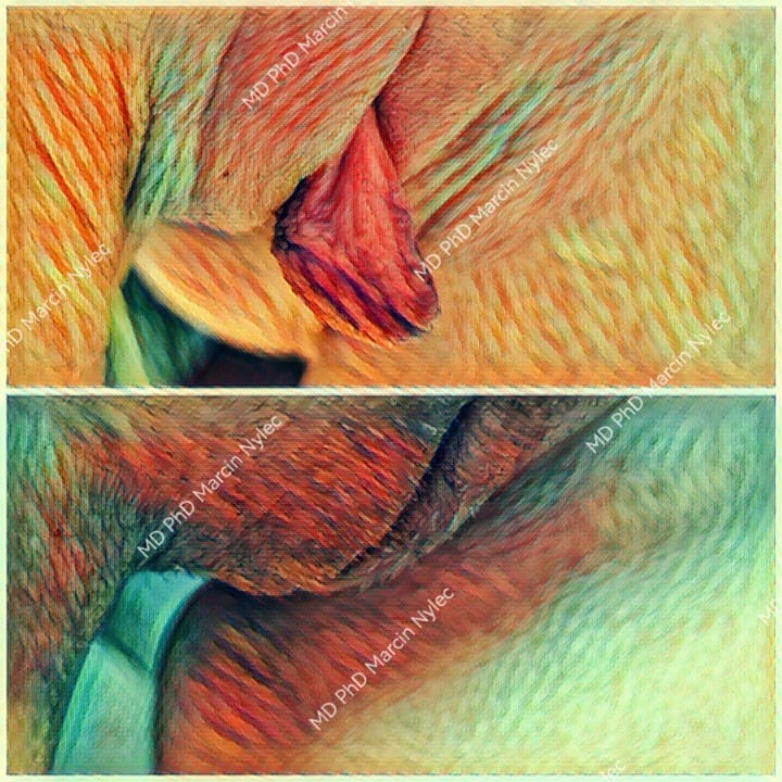 Zestawienie zdjęć przed i po labioplastyce, widok warg sromowych z boku w pozycji stojącej