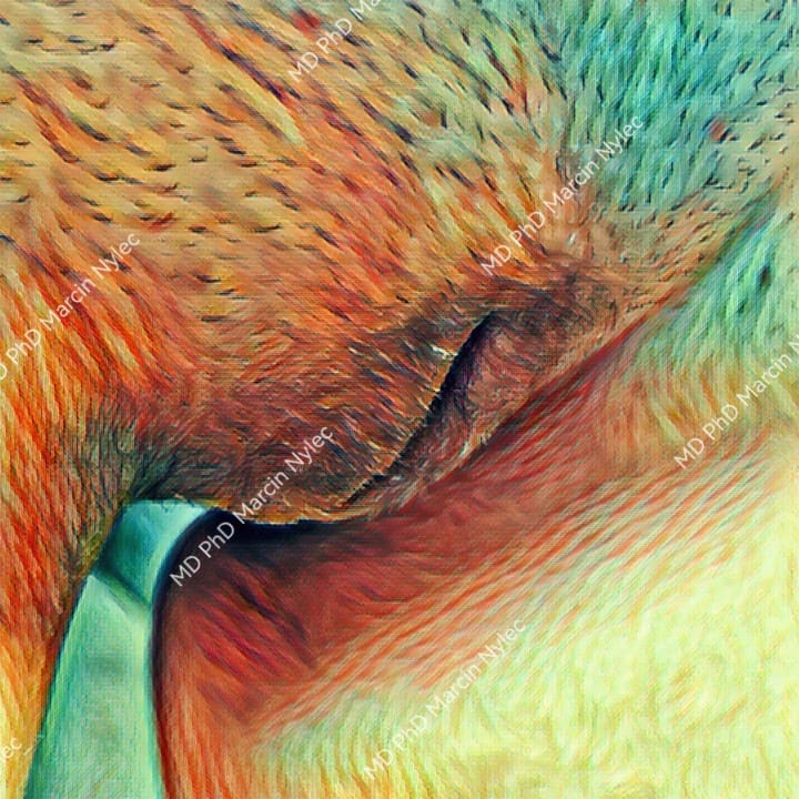 Harmonijny wygląd warg sromowych po zabiegu: widok z boku w pozycji stojącej