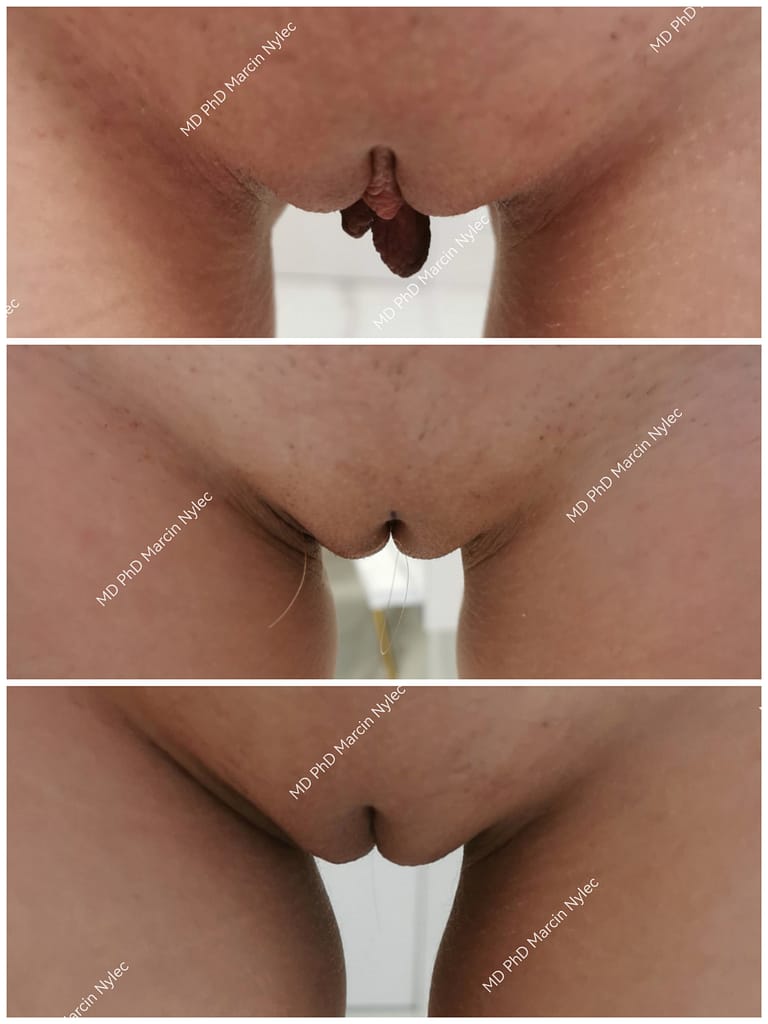 Labioplastyka Przed & Po Pacjent #642 zdjęcie #122